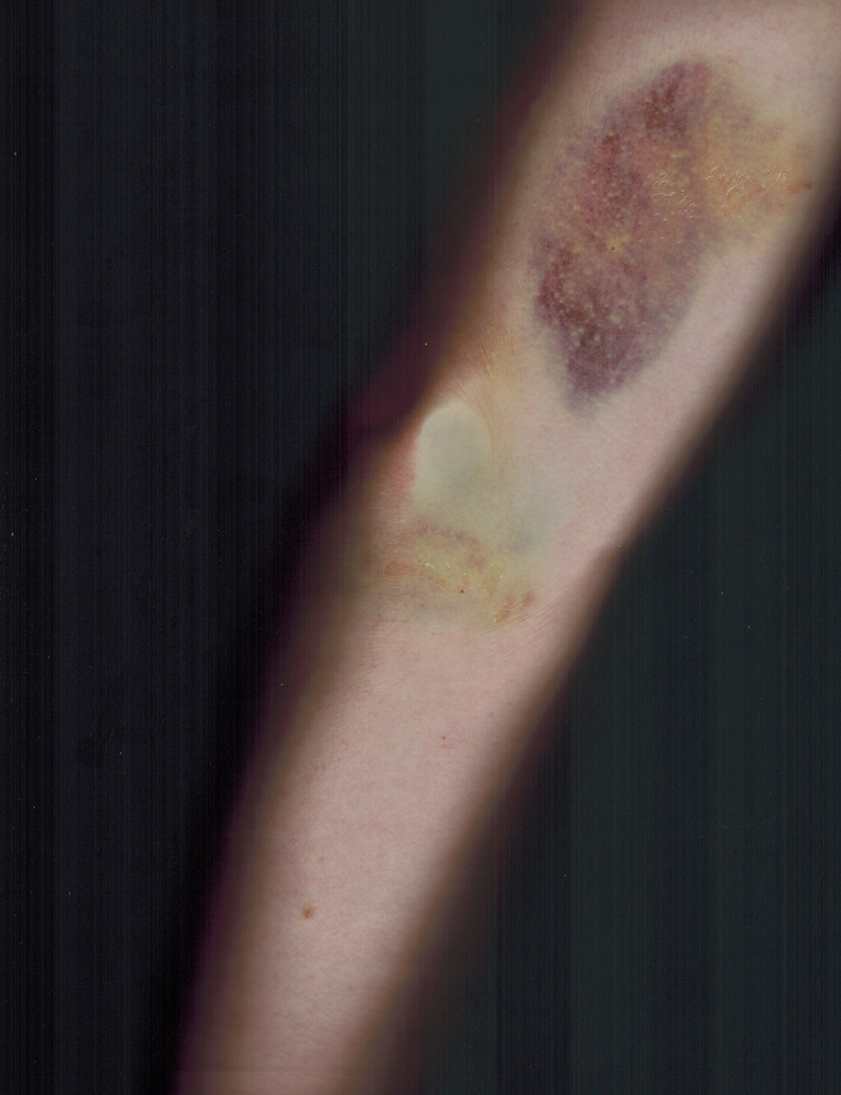 image of an arm with a bruise